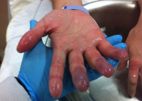 Một trường hợp bị bỏng lạnh do sử dụng đá khô sai cách.