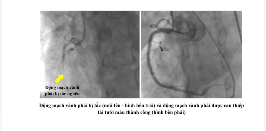 Tình trạng nguy kịch của bệnh nhân khi nhập viện. (Ảnh: Sở Y tế TP HCM)