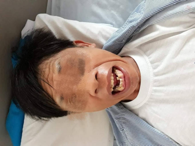 Bệnh nhân bị cứng hàm, nói khó sau khi bị dằm tre đâm vào tay gây uốn ván. (Ảnh: BVCC)