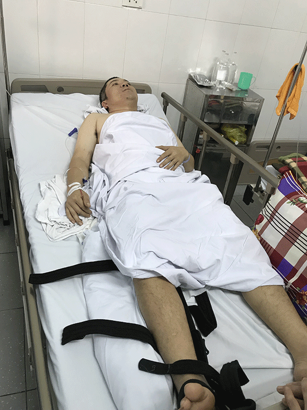 Anh Trường bị gãy xương đùi phức tạp (gãy xương, có nhiều mảnh nhỏ rời).