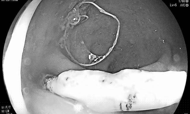 Vòng tránh thai đâm thủng trực tràng. (Ảnh: Bệnh viện cung cấp)