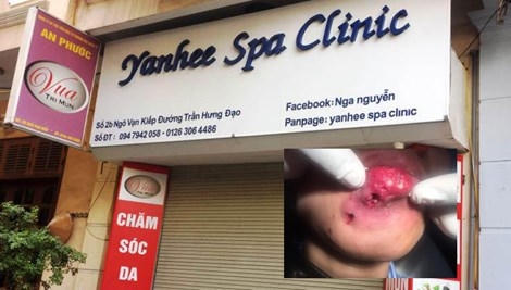 Những vụ hoại tử khủng khiếp do thẩm mỹ hỏng ở Việt Nam