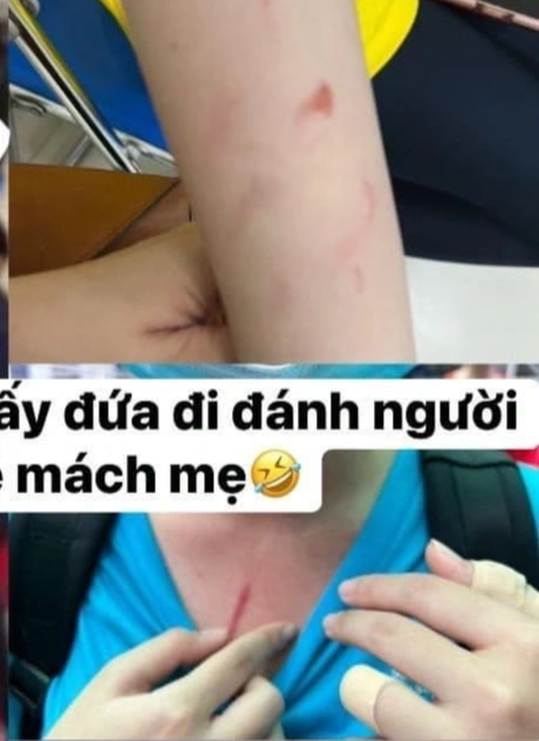 Người mẹ chia sẻ hình ảnh thương tích của các nữ sinh sau cuộc ẩu đả. (Ảnh: T.H.T)