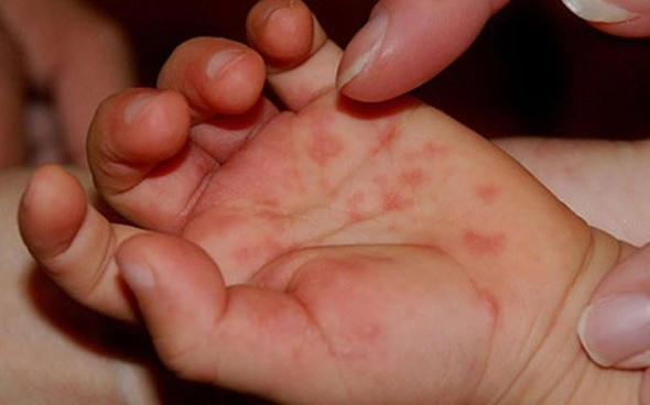Tay chân miệng là một trong những bệnh ngoài da do nhiễm vi rút thường gặp ở trẻ em, khả năng lây nhiễm cao và dễ gây nhiều biến chứng. Ảnh: minh họa.