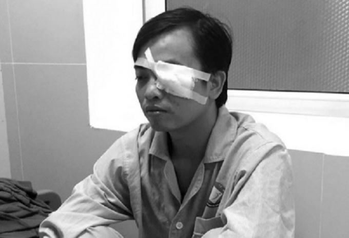 Bác sĩ Trần Văn Sơn phải điều trị chấn thương nặng vùng mắt do bị hành hung.