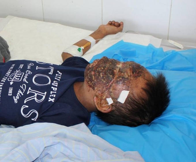 Ngã vào bếp lửa đang cháy khuôn mặt của bé trai bị bỏng gần như hoàn toàn, một mắt của em cũng đã hỏng, mắt còn lại cũng bị bỏng rất nặng.