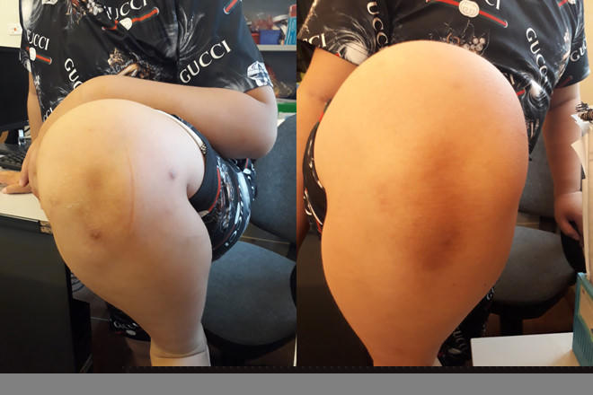 Vết thương ở gối sau nhiều lần bị bắt quỳ trên đáy bát, ghạch vỡ  Ảnh Trần Cường