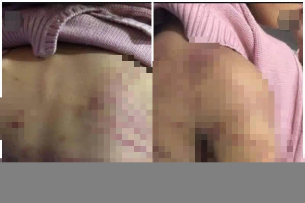 Cháu B. bị bạo hành với nhiều vết thương khắp cơ thể