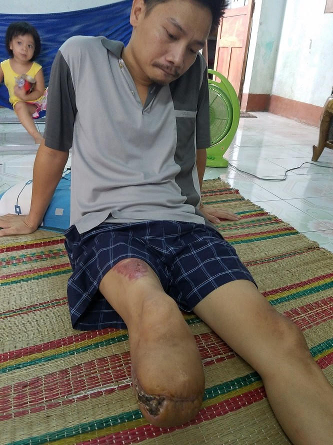 Nạn nhân bị cưa 1/3 chân