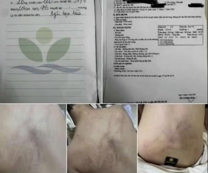 Hình ảnh thương tích và kết quả thăm khám bước đầu của cháu bé bị bạo hành tại trường mầm non Gia Thụy.