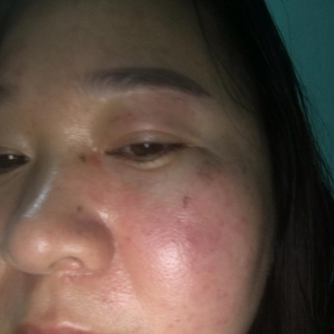 Khuôn mặt sưng tấy của chị Nhung sau khi bị ông Vũ hành hung.