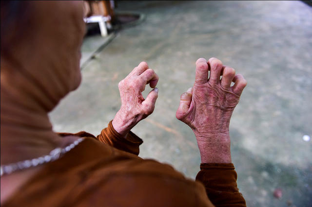 Những đôi bàn tay không lành lặn đã mấy chục năm làm đủ công việc phục vụ cuộc sống như nấu cơm, quét nhà, cuốc đất trồng rau…