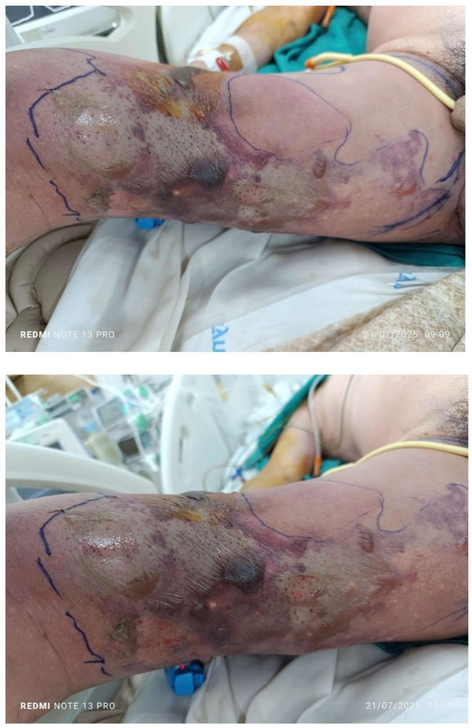 Tổn thương lan nhanh chóng từ một vết đốt nhỏ nhiễm vi khuẩn Vibrio vulnificus sau khi tắm biển. (Ảnh: Bệnh viện Bạch Mai)
