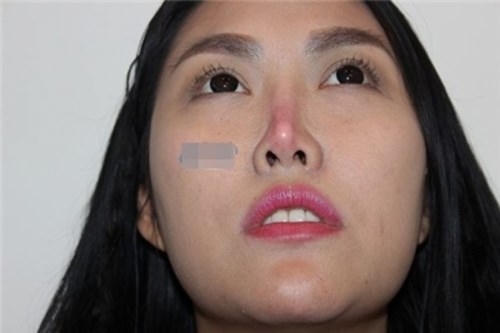 Những vụ hoại tử khủng khiếp do thẩm mỹ hỏng ở Việt Nam