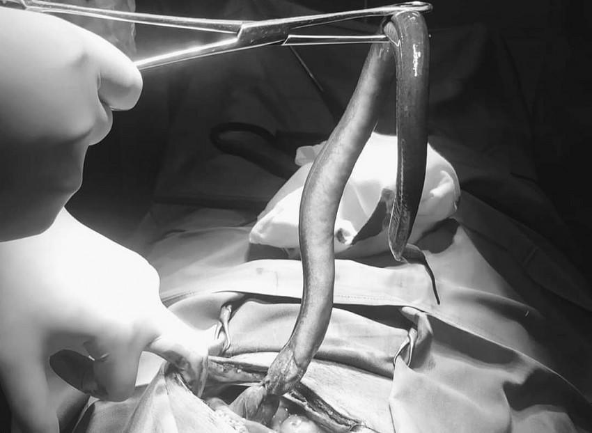 Con lươn được các bác sĩ gắp ra khỏi ổ bụng nạn nhân