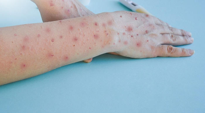 benh-lay-tu-nguoi-sang-nguoi