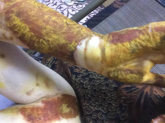 Nữ sinh Đinh Diệp Anh bị bỏng nặng do nổ cồn trong phòng thực hành hóa