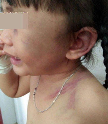 Bé Vân đau đớn với những vết thương do Pháp đánh.