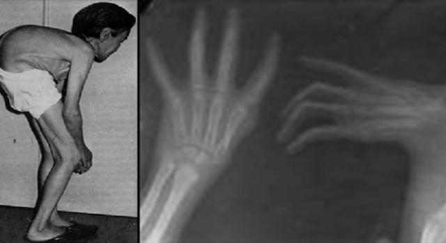 Căn bệnh kinh hoàng được đặt tên theo tiếng kêu khóc người trúng độc