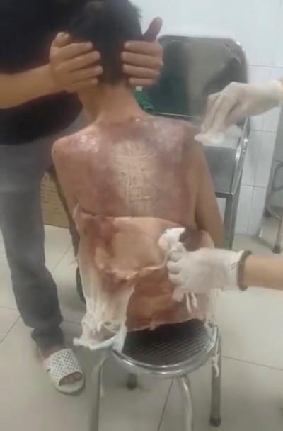 Bé trai đang được điều trị bỏng tại bệnh viện