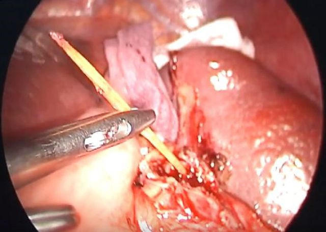 Cây tăm dài 6cm đâm thủng lách được gắp ra ngoài thành công