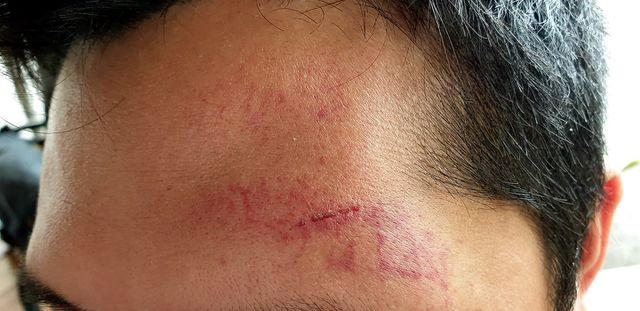 Vết thương trên phần đầu anh T. do nhóm người lạ mặt gây ra.
