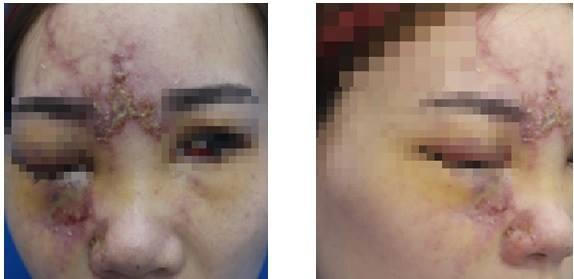 Cô gái mù mắt phải do tiêm filler làm đẹp