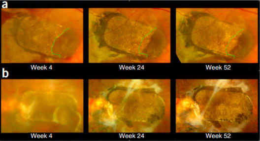 Ảnh chụp đáy mắt cho thấy các tế bào mới sẫm màu hơn đã mọt lên quanh miếng dán sau một năm.