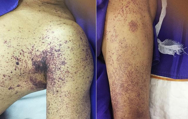 Ăn tiết canh giải đen cuối năm, 1 qu&yacute; &ocirc;ng mất mạng