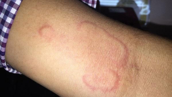 Giun lươn bò ngoằn nghoèo dưới da.