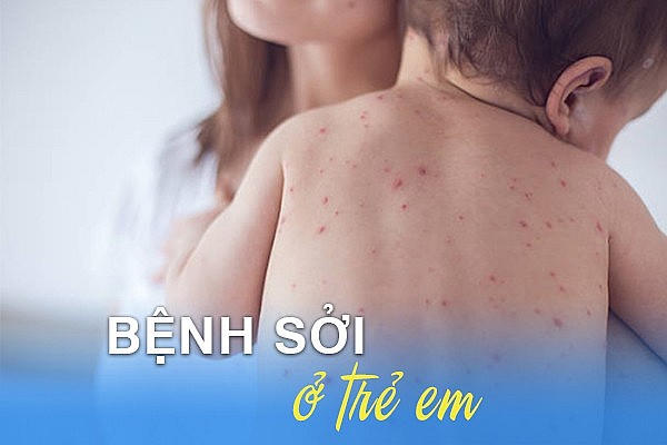Hà Nội: Số ca sởi chân tay miệng tiếp tục gia tăng. (Ảnh minh hoạ)