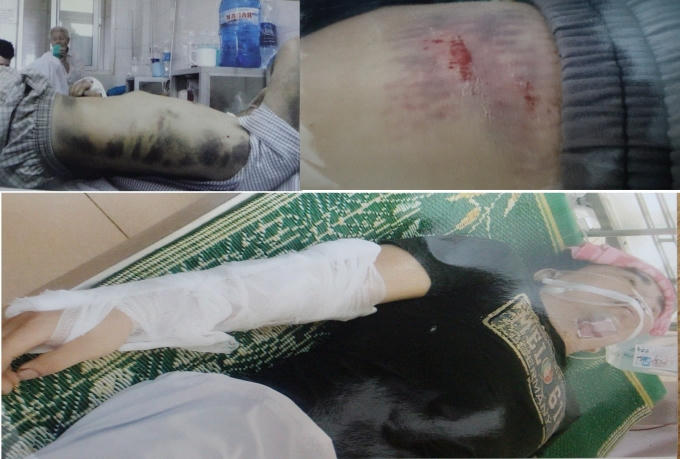 Nạn nhân bị đánh gãy cánh tay phải, dập lá lách độ 3, thiếu máu trầm trọng, toàn thân bầm tím,...