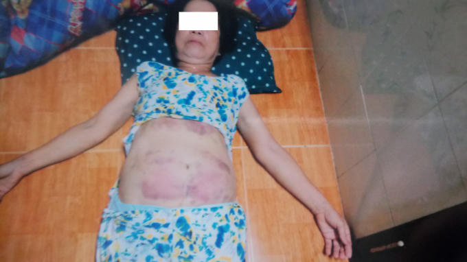 Hình ảnh bà Hoa bị chấn thương sau khi bị đánh.