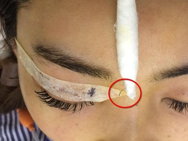 Hình ảnh chiếc kim sau khi được BV Mắt TƯ lấy ra