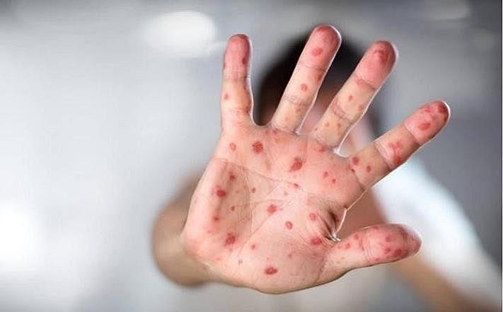 Trong 3 tháng đầu năm, Hà Nội đã ghi nhận 685 ca tay chân miệng.