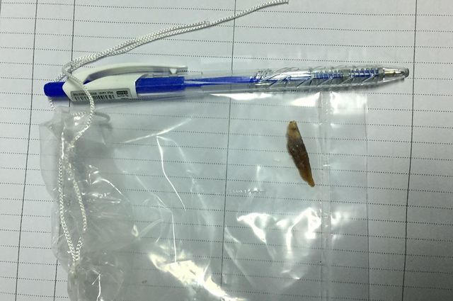 Mảnh xương được lấy trong ruột bệnh nhân. Ảnh do Bác sĩ Trịnh Thanh Trầm phẫu thuật cung cấp