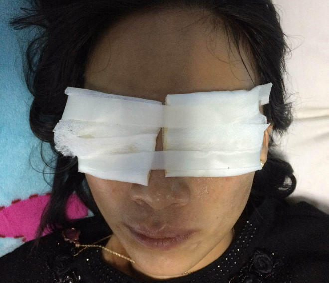 Chị H. bị mẹ chồng tạt a xít vào mặt. (Ảnh. Zing)