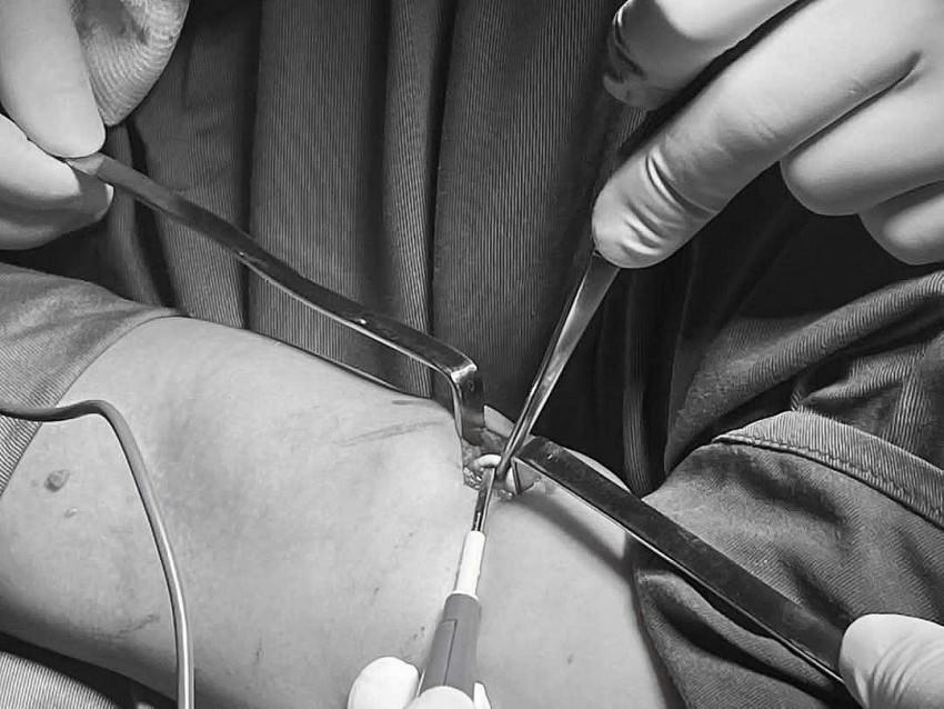 Bệnh viện Sản Nhi Nghệ An lấy thành công que tránh thai “đi lạc”.