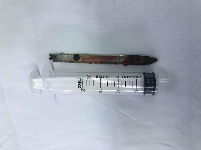 Lưỡi dao dài đến 13 cm được lấy ra khỏi cơ thể nam bệnh nhân sau 11 năm.