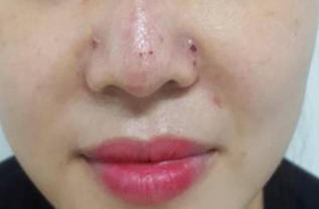 Người phụ nữ gặp biến chứng vì tiêm filler nâng mũi tại spa