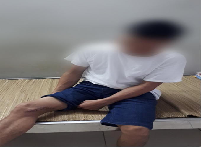 Nông dân bị bệnh Whimore khi vi khuẩn xâm nhập qua vết thương do bừa tại Thái Nguyên