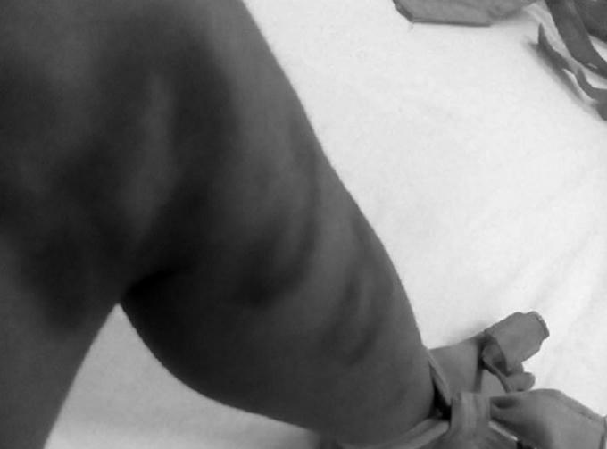 Cháu Hùng nghi bị người tình của mẹ bạo hành.