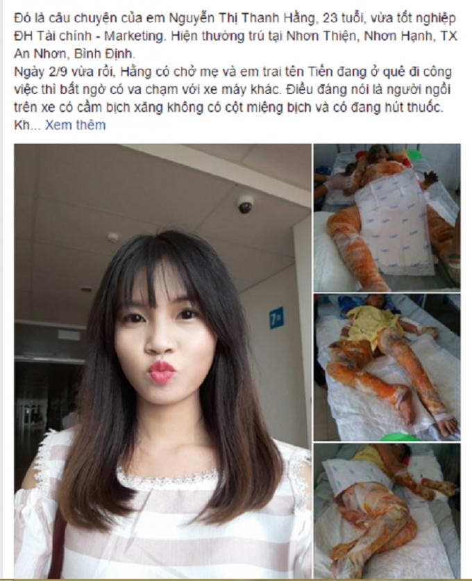 Tân cử nhân Đại học Tài Chính bị xăng đốt cháy và bỏng nặng. (Nguồn: Facebook).