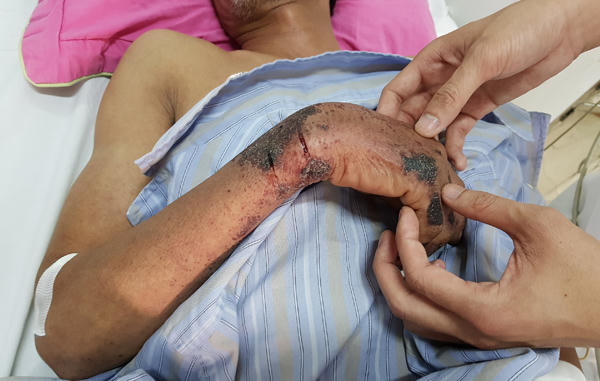 Tay bệnh nhân 60 tuổi với nhiều vết hoại tử, nứt sâu, chảy máu (Vietnamnet.vn)