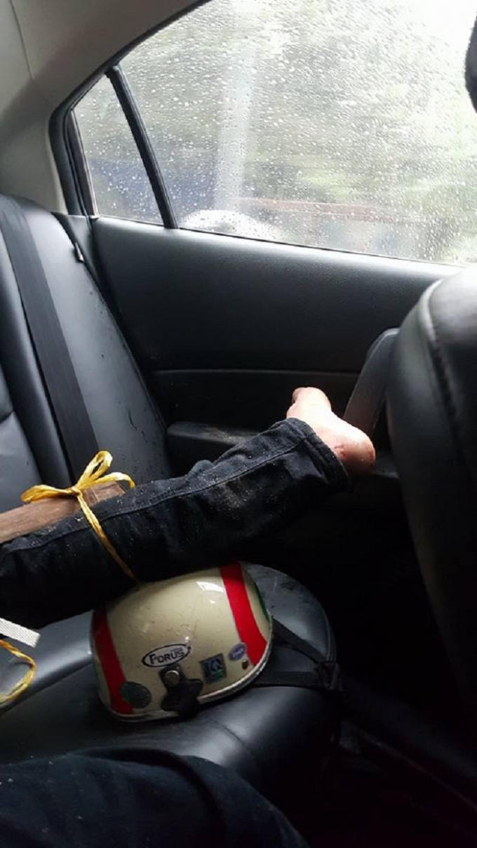 Chân của nạn nhân được cố định trước khi đến bệnh viện. Nguồn: Phạm Hồng Quân/www.otofun.net