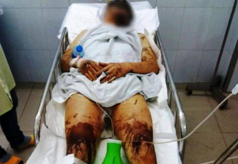 Toàn thân anh Nghiêm bị bỏng nặng. (Ảnh NLĐ)