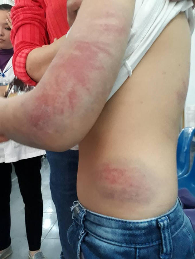 Đến lớp cô giáo mới phát hiện trên người H. có nhiều vết thâm tím (ảnh facebook)