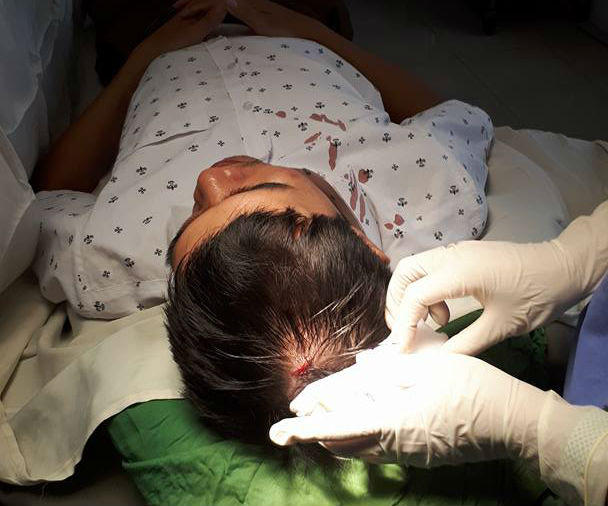Bác sỹ Nguyễn Văn Long bị khâu 5 mũi ở đầu.