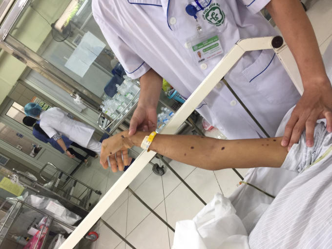 Vết ong đốt trên tay bệnh nhân. Ảnh: BVCC