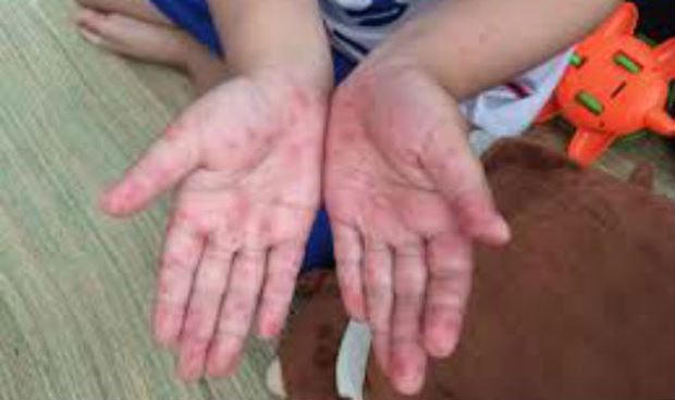 Lo ngại chủng vi r&uacute;t Enterovirus 71 t&aacute;i xuất g&acirc;y tay - ch&acirc;n - miệng